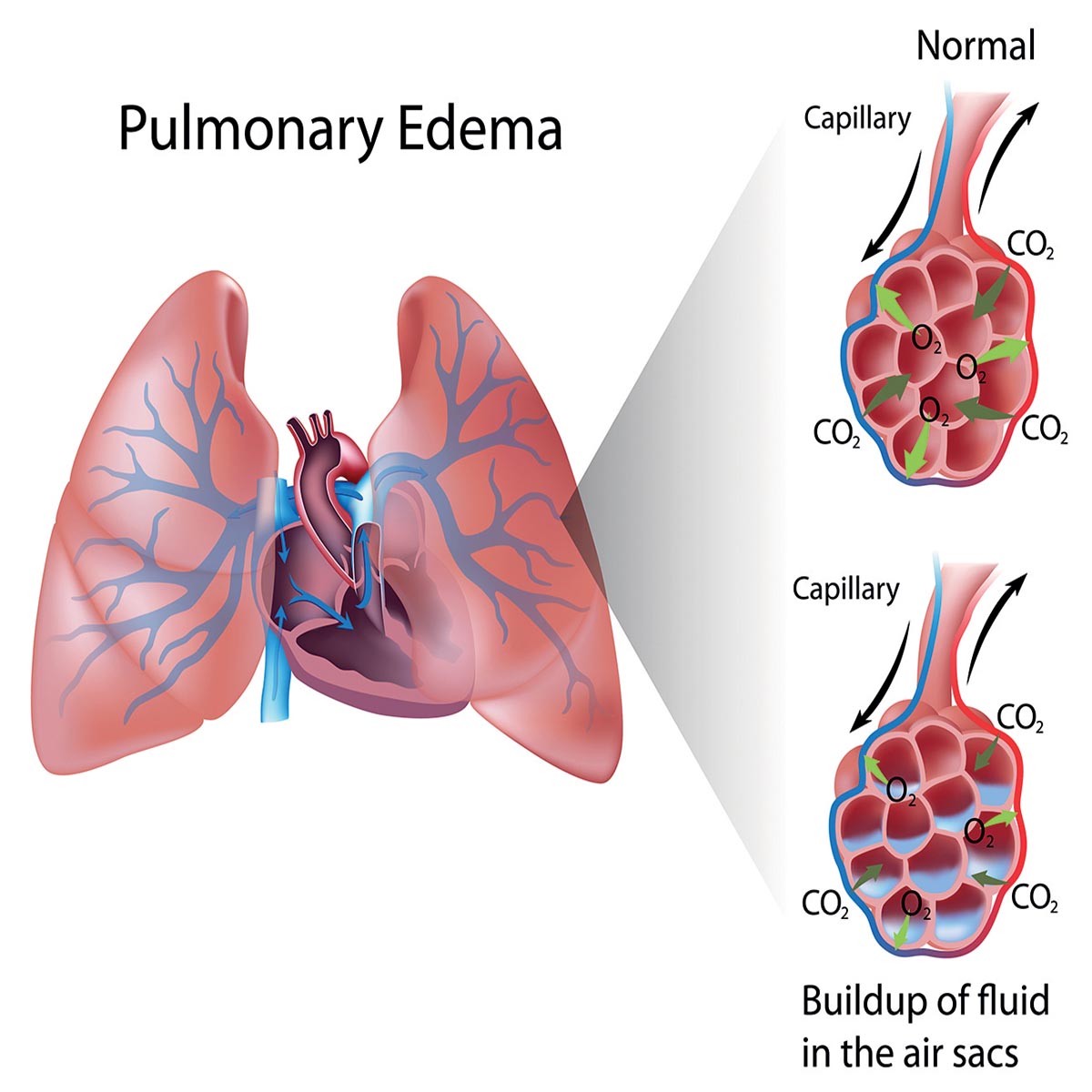 caslypso news edema3